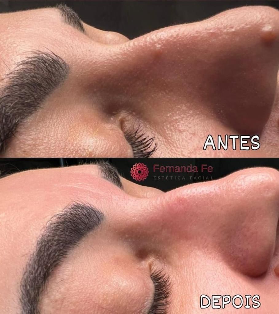 Antes e depois 1