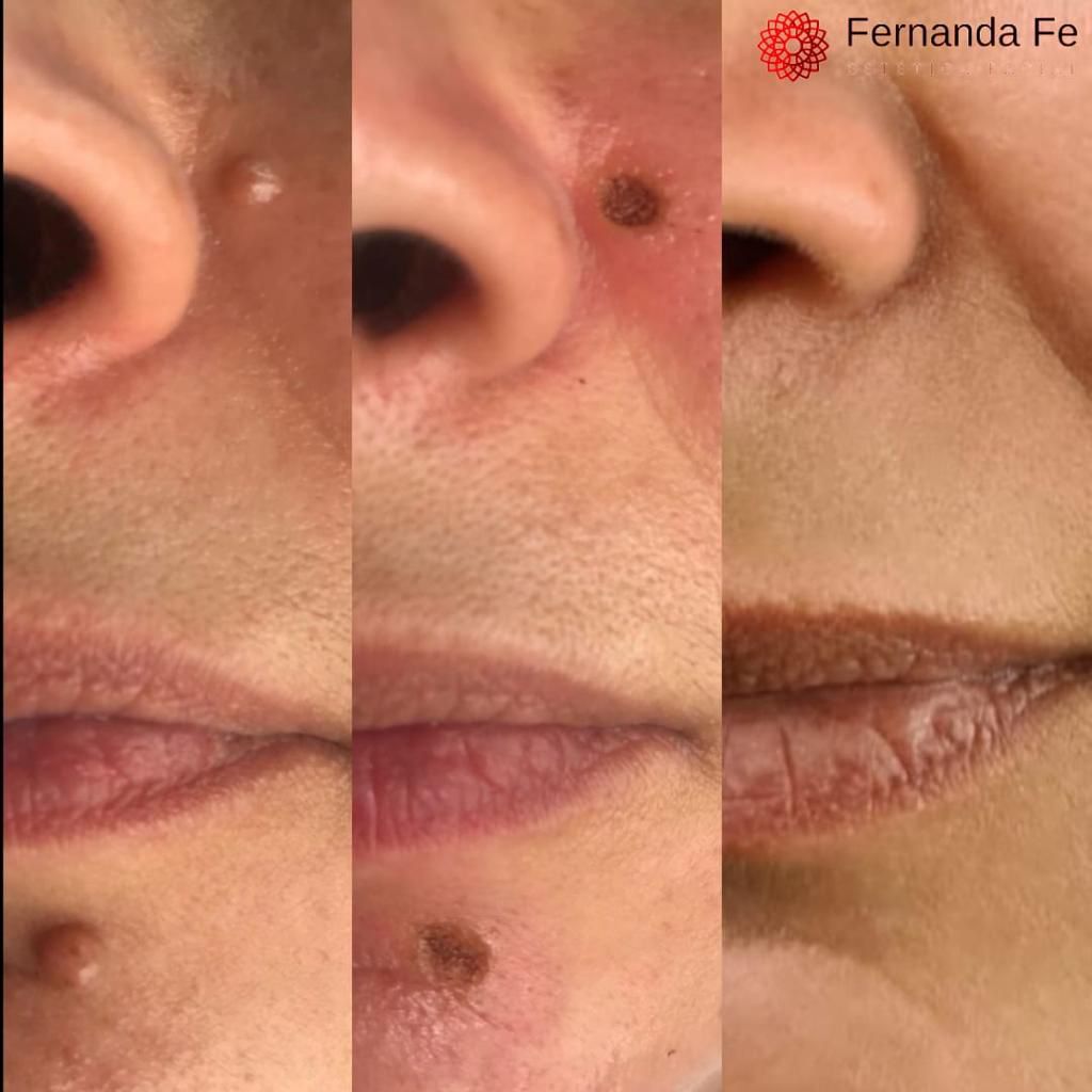 Antes e depois 2